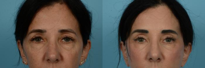 Before & After Brow Lift by Dr. Sinno Case 1111 Front View in Chicago, IL
