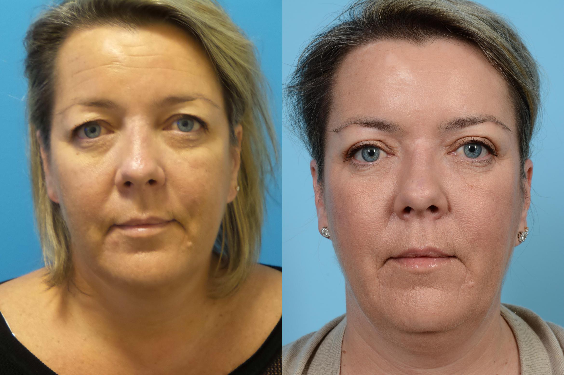 Brow Lift Case 442 Before & After View #1 | Chicago, IL | TLKM Plastic Surgery