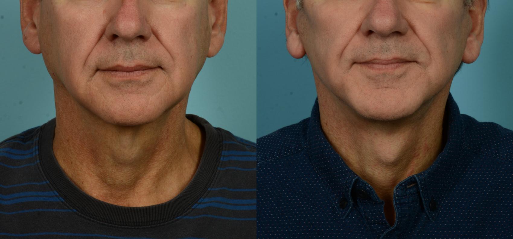 Before & After (cropped) Neck Lift by Dr. Mustoe Case 1082 Front View in Chicago, IL