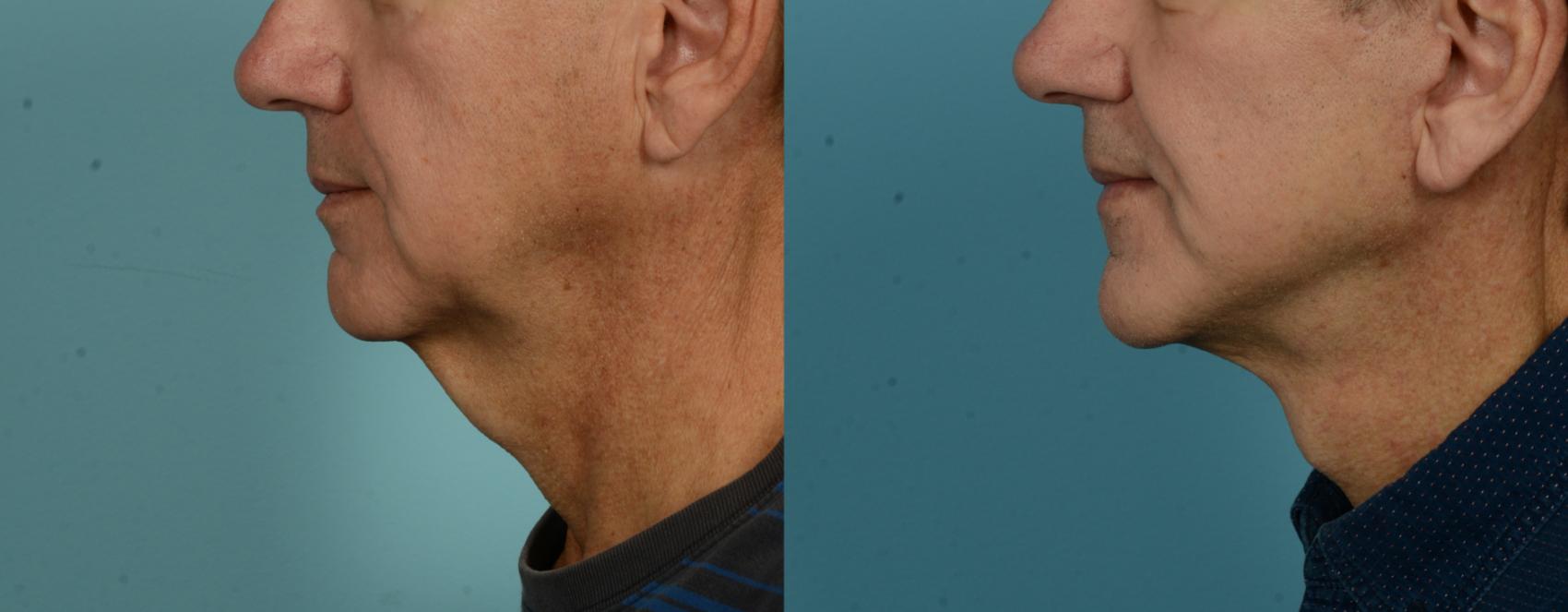 Before & After (cropped) Neck Lift by Dr. Mustoe Case 1082 Left Side View in Chicago, IL