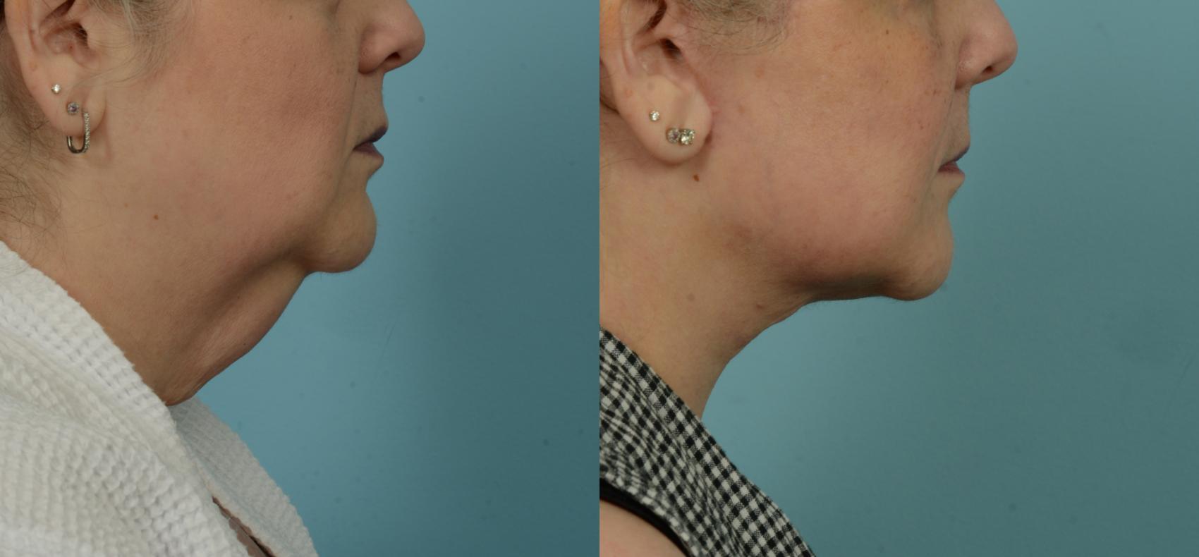 Before & After (cropped) Neck Lift by Dr. Mustoe Case 995 Right Side View in Chicago, IL