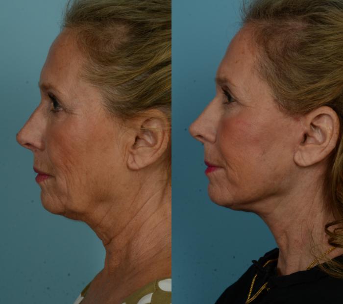 Before & After Laser Resurfacing by Dr. Mustoe Case 1023 Left Side View in Chicago, IL