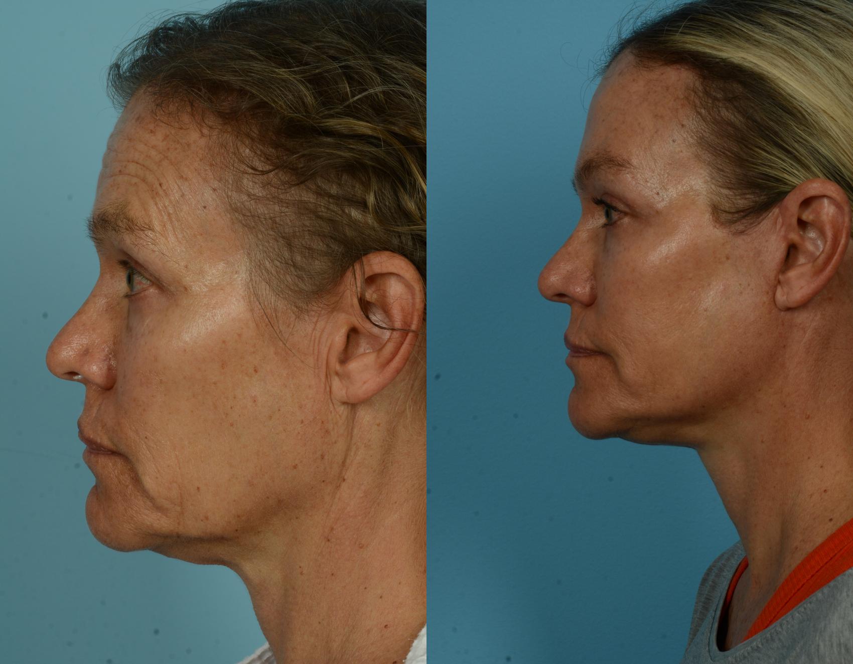 Before & After Deep Plane Facelift by Dr. Mustoe Case 1040 Left Side View in Chicago, IL