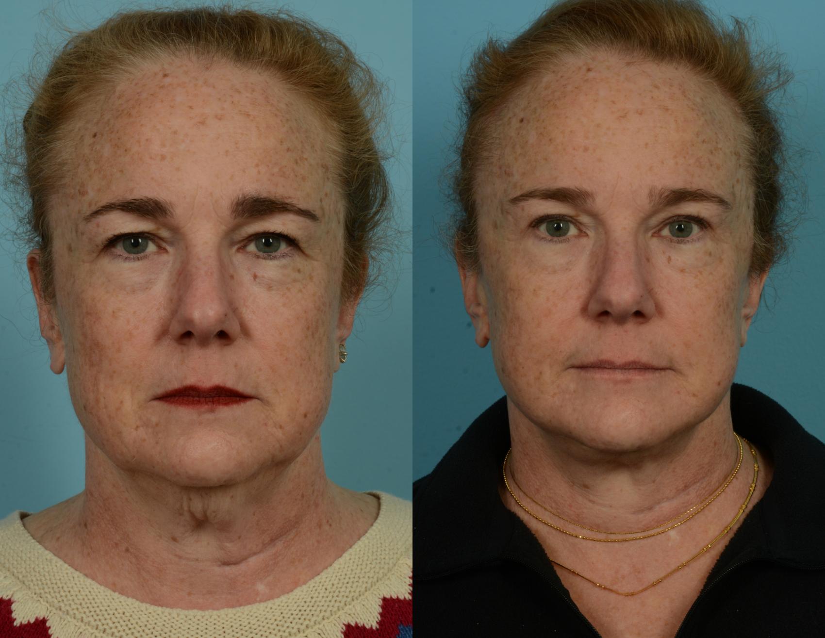 Before & After Deep Plane Facelift by Dr. Mustoe Case 1052 Front View in Chicago, IL