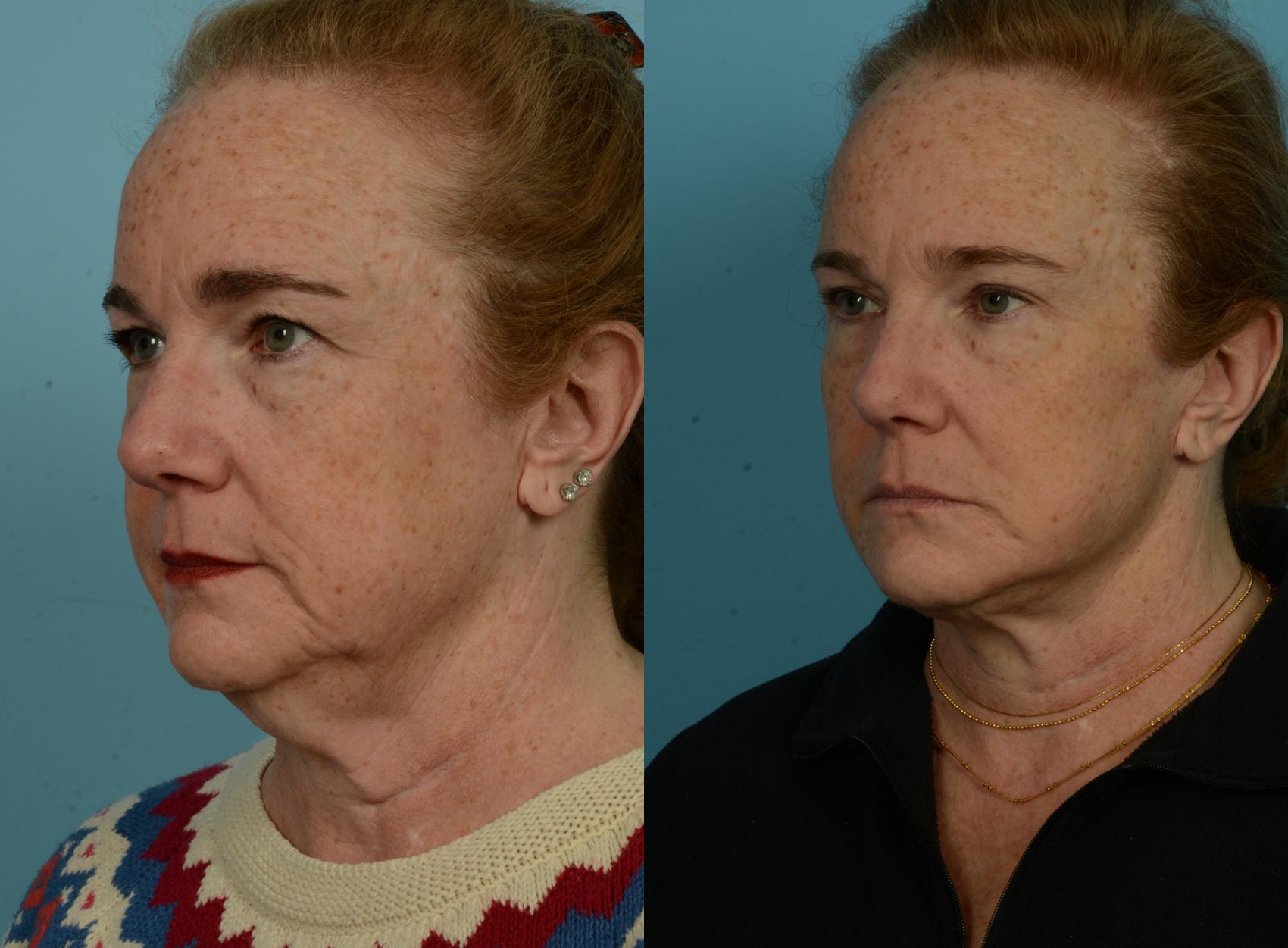 Before & After Deep Plane Facelift by Dr. Mustoe Case 1052 Left Oblique View in Chicago, IL