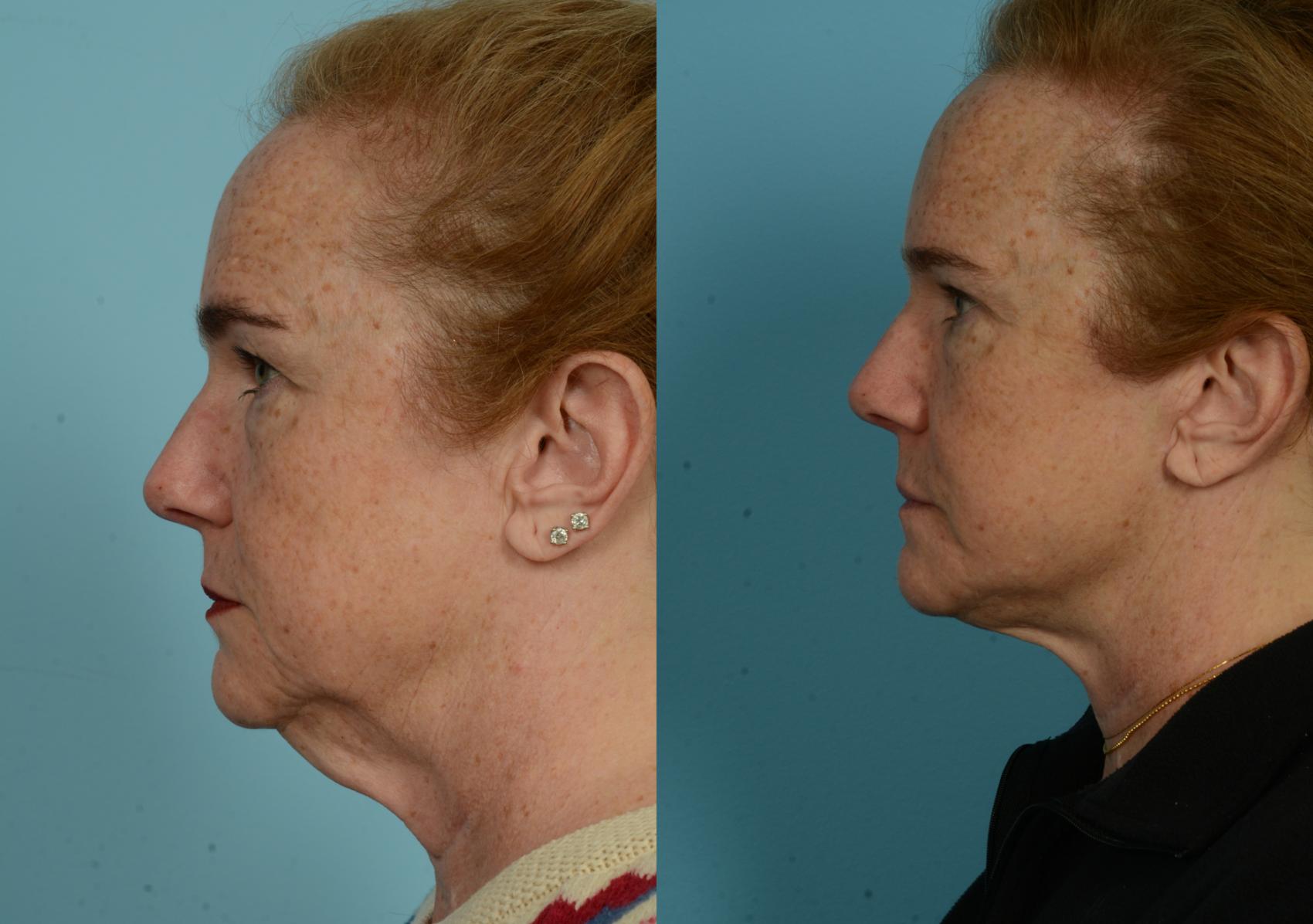 Before & After Deep Plane Facelift by Dr. Mustoe Case 1052 Left Side View in Chicago, IL