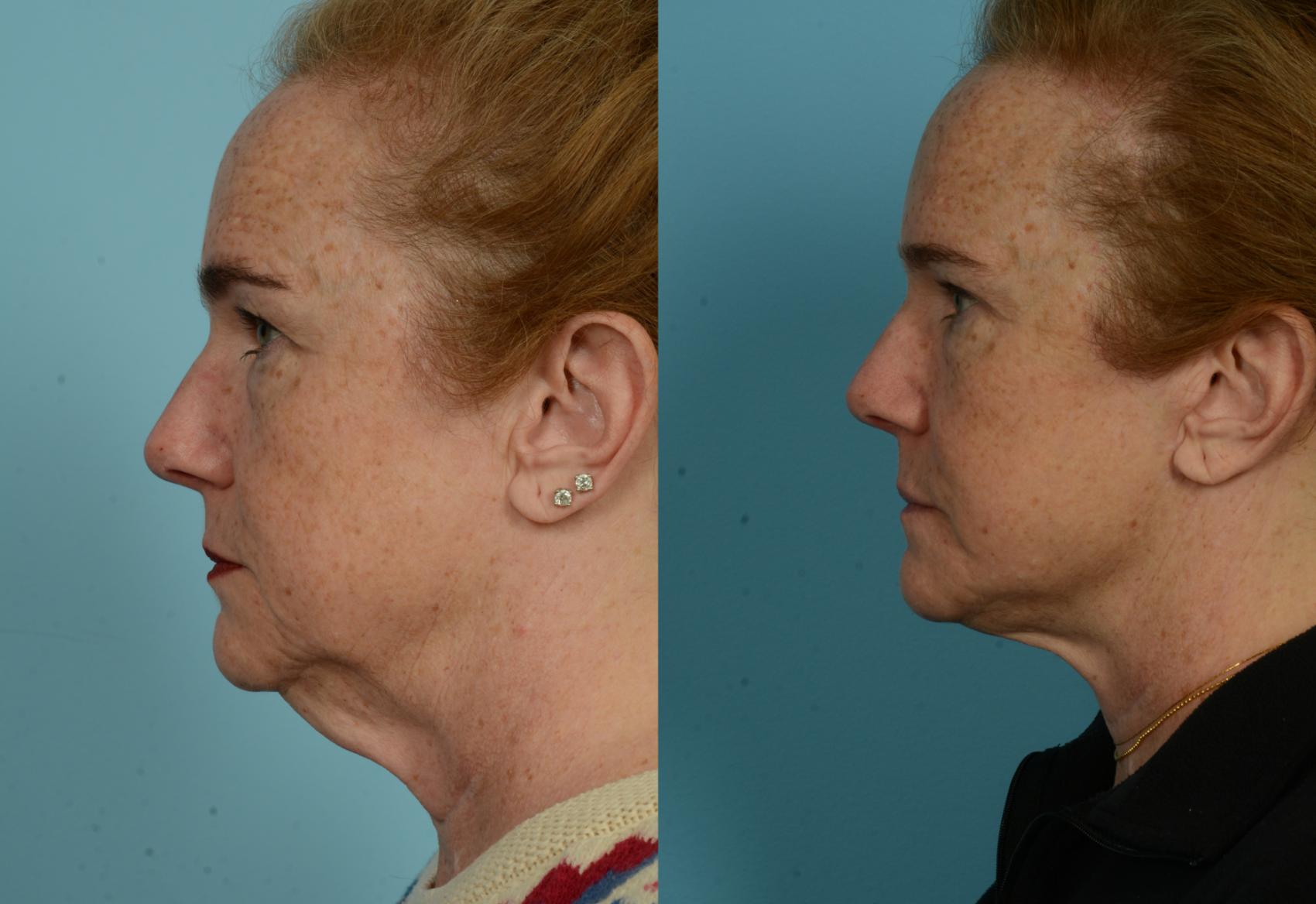 Before & After Deep Plane Facelift by Dr. Mustoe Case 1052 Right Side View in Chicago, IL