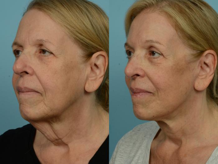 Before & After Deep Plane Facelift by Dr. Mustoe Case 1057 Left Oblique View in Chicago, IL