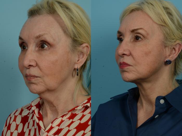 Before & After Deep Plane Facelift by Dr. Mustoe Case 1074 Left Oblique View in Chicago, IL