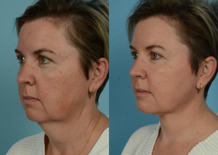 Before & After Deep Plane Facelift by Dr. Mustoe Case 1079 Left Oblique View in Chicago, IL