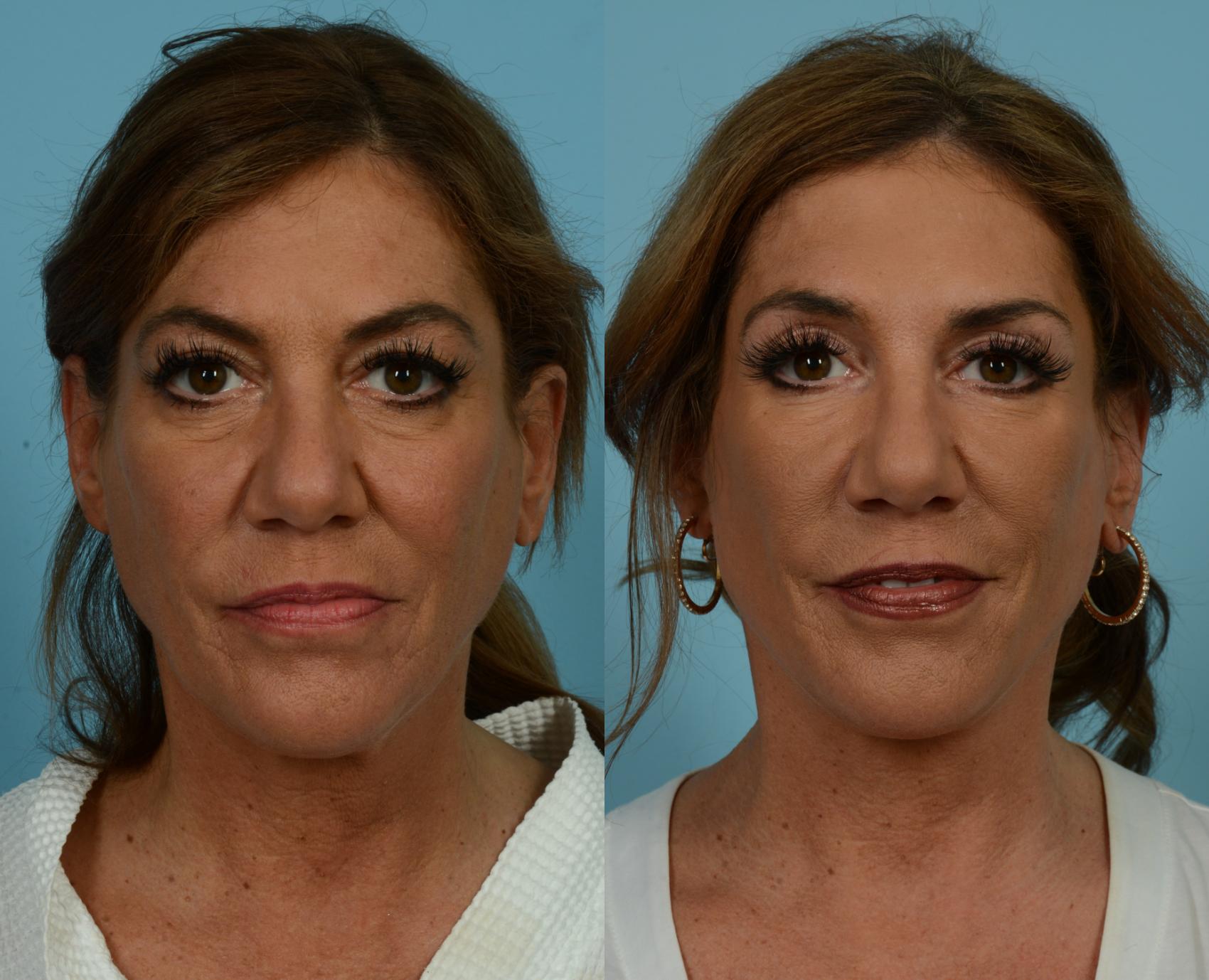Before & After Deep Plane Facelift by Dr. Mustoe Case 1080 Front View in Chicago, IL