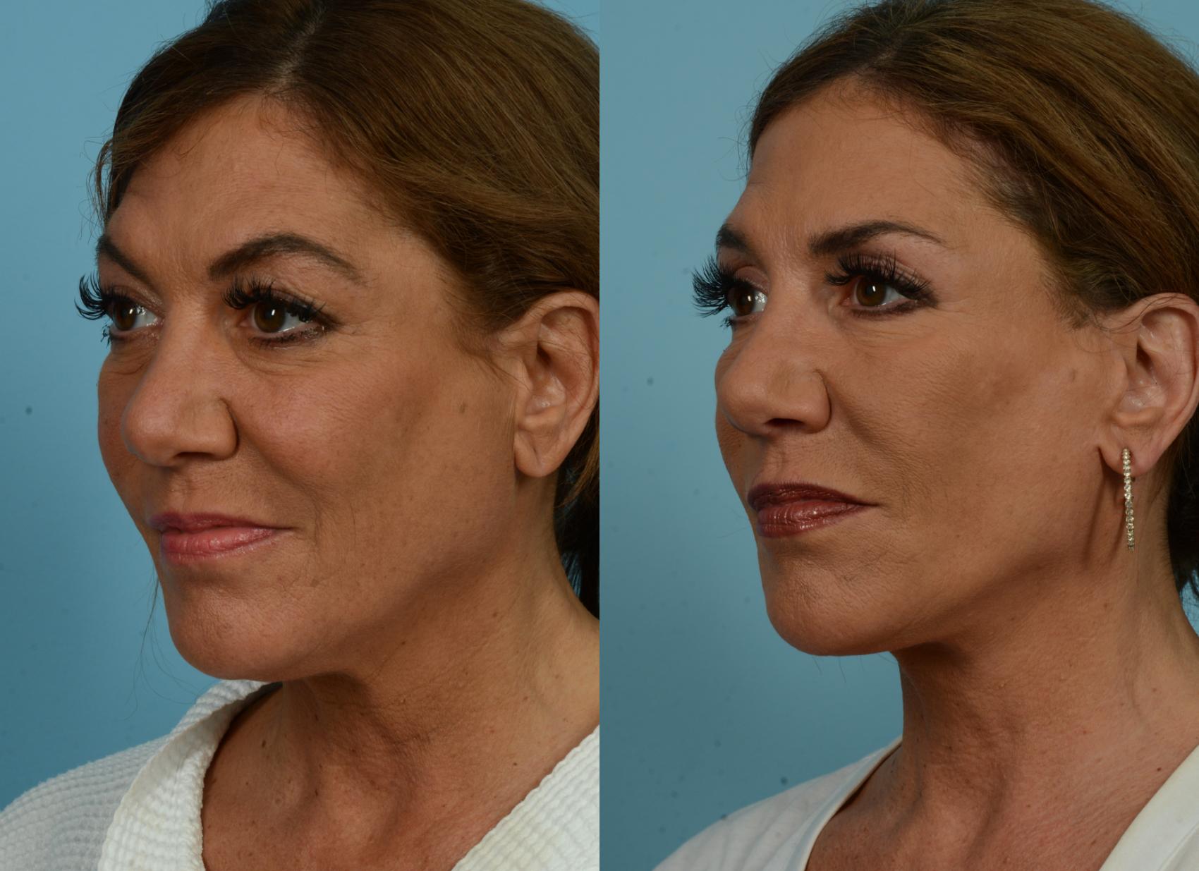 Before & After Deep Plane Facelift by Dr. Mustoe Case 1080 Left Oblique View in Chicago, IL