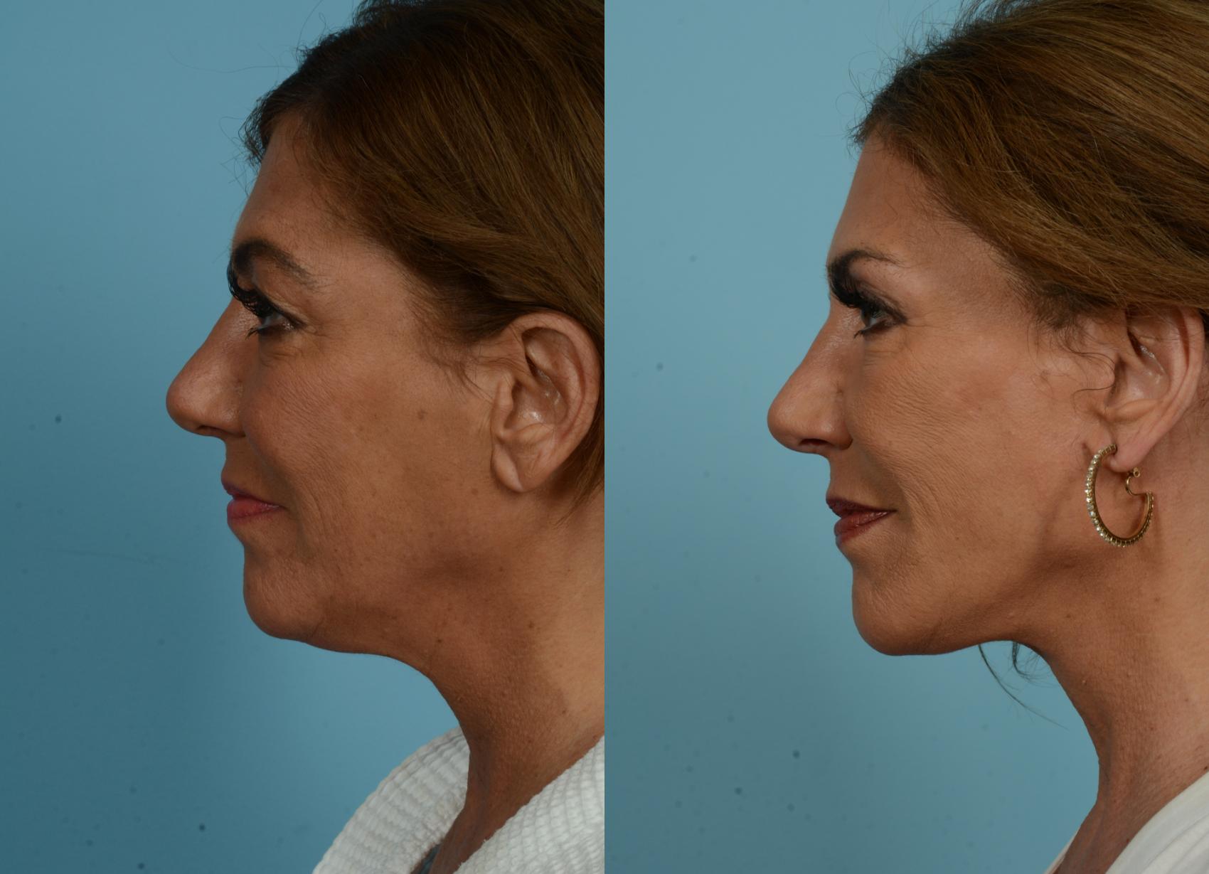 Before & After Deep Plane Facelift by Dr. Mustoe Case 1080 Left Side View in Chicago, IL
