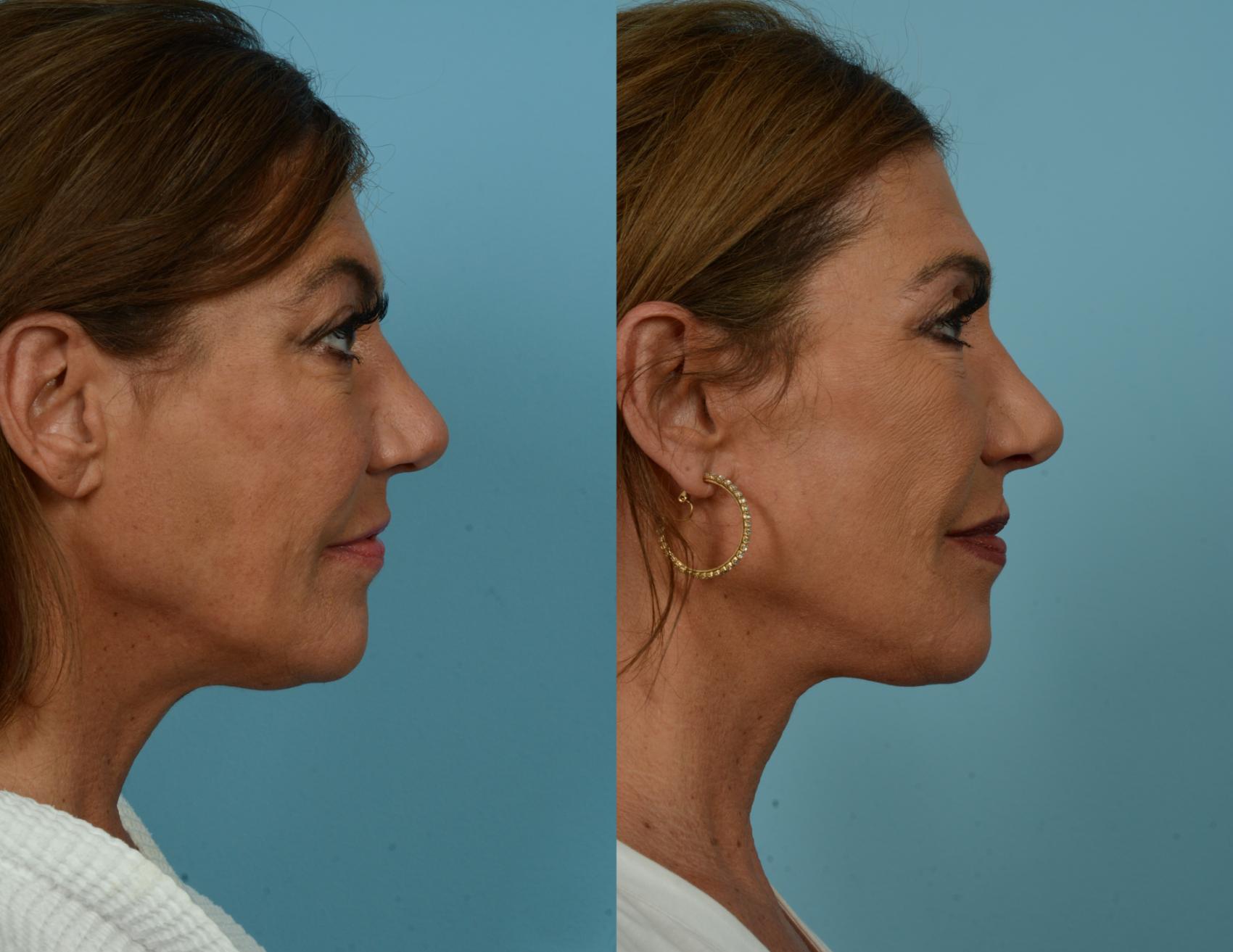 Before & After Deep Plane Facelift by Dr. Mustoe Case 1080 Right Side View in Chicago, IL