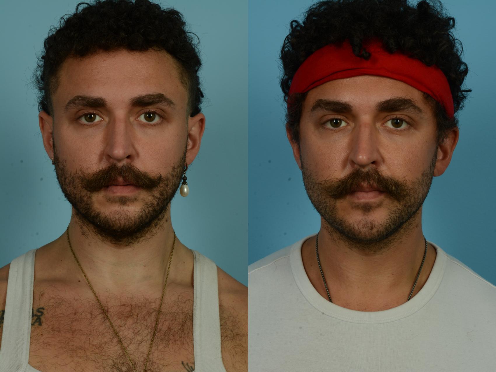 Before & After Deep Plane Facelift by Dr. Mustoe Case 1090 Front View in Chicago, IL