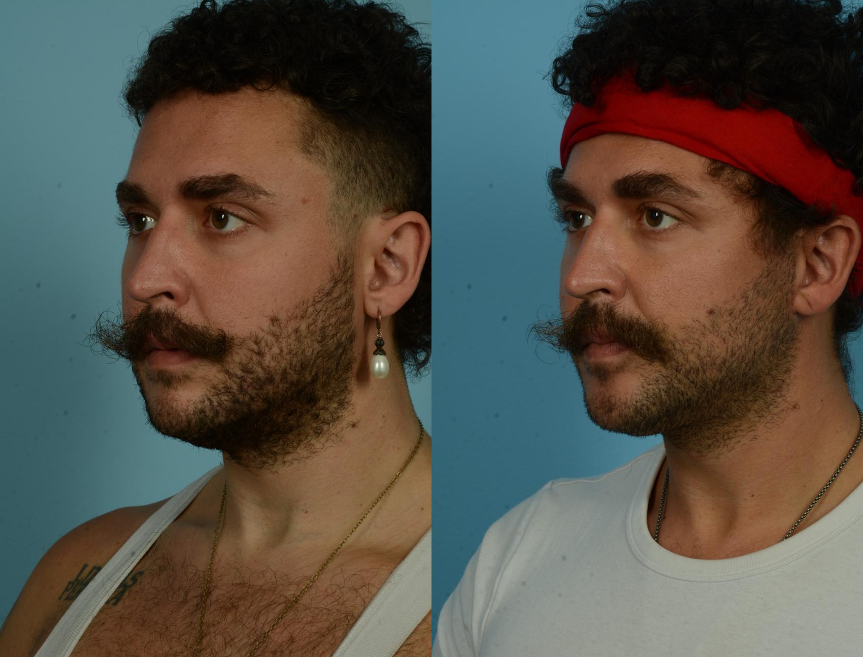 Before & After Deep Plane Facelift by Dr. Mustoe Case 1090 Left Oblique View in Chicago, IL