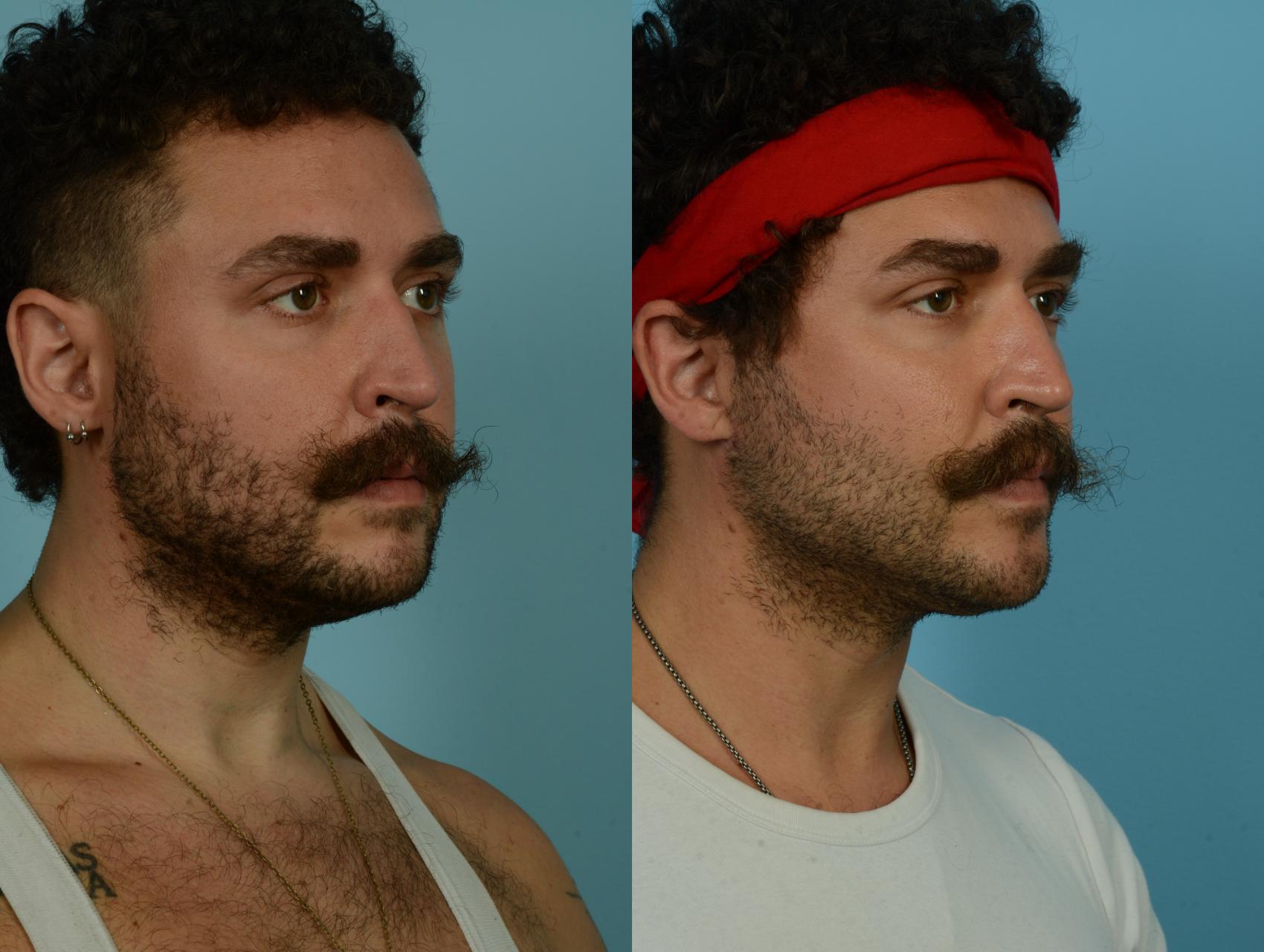 Before & After Deep Plane Facelift by Dr. Mustoe Case 1090 Right Oblique View in Chicago, IL