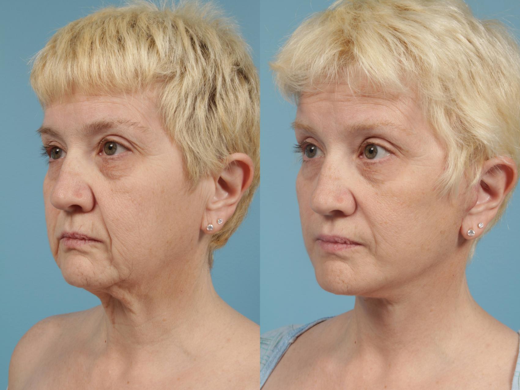 Before & After Deep Plane Facelift by Dr. Mustoe Case 170 Left Oblique View in Chicago, IL
