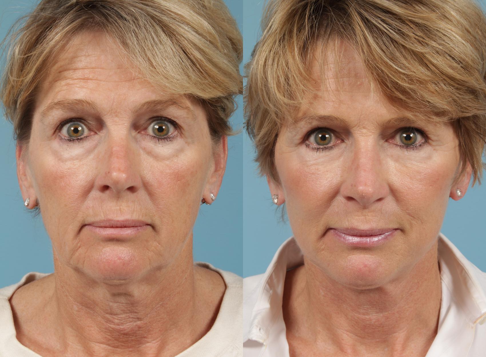 Before & After Deep Plane Facelift by Dr. Mustoe Case 216 Front View in Chicago, IL