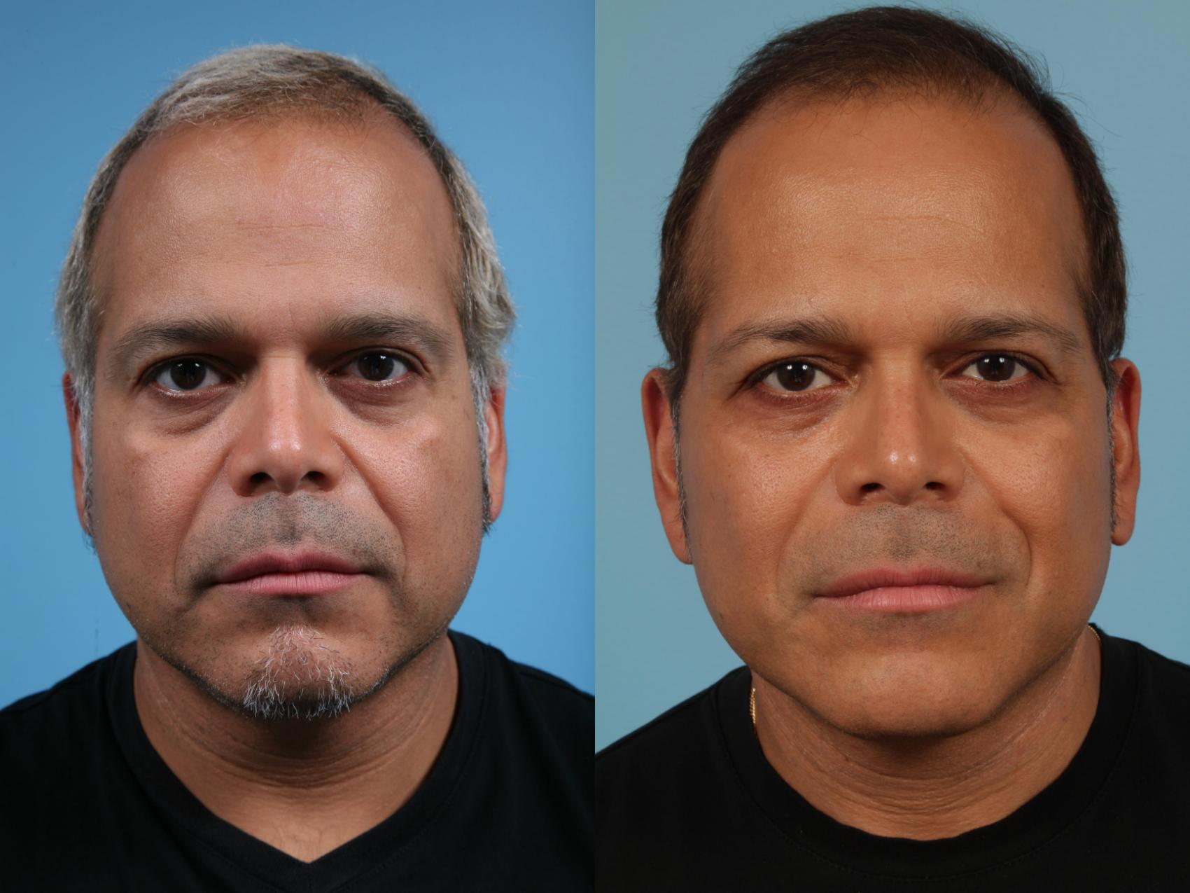 Before & After Deep Plane Facelift by Dr. Mustoe Case 229 View #1 View in Chicago, IL