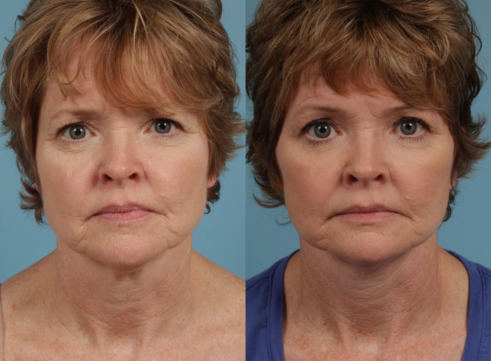 Before & After Deep Plane Facelift by Dr. Mustoe Case 285 View #2 View in Chicago, IL