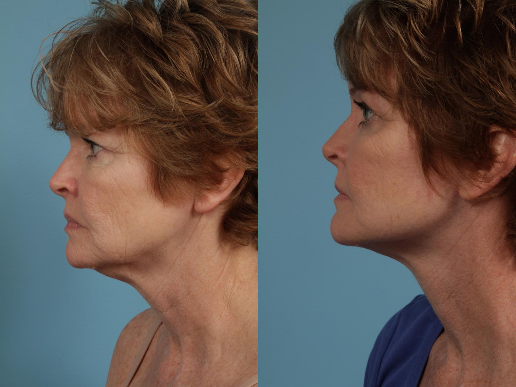 Before & After Deep Plane Facelift by Dr. Mustoe Case 285 View #3 View in Chicago, IL