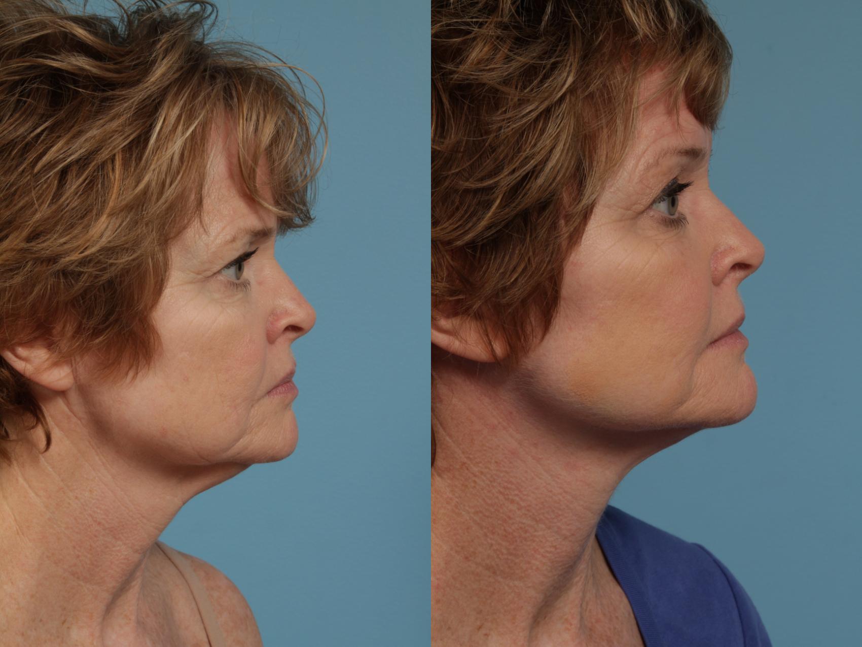 Before & After Deep Plane Facelift by Dr. Mustoe Case 285 View #4 View in Chicago, IL