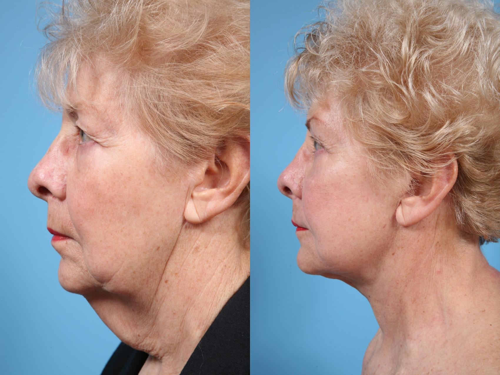 Before & After Deep Plane Facelift by Dr. Mustoe Case 69 View #4 View in Chicago, IL