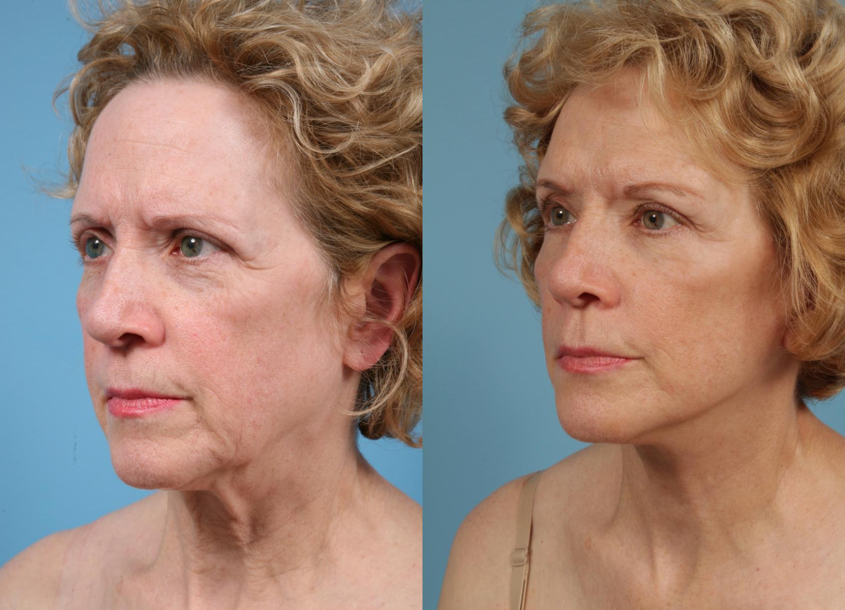 Before & After Deep Plane Facelift by Dr. Mustoe Case 76 Left Oblique View in Chicago, IL
