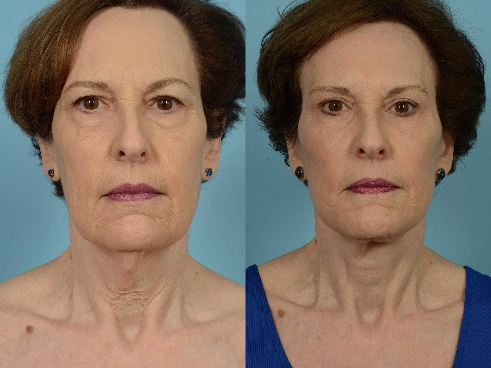 Before & After Deep Plane Facelift by Dr. Mustoe Case 796 Front View in Chicago, IL