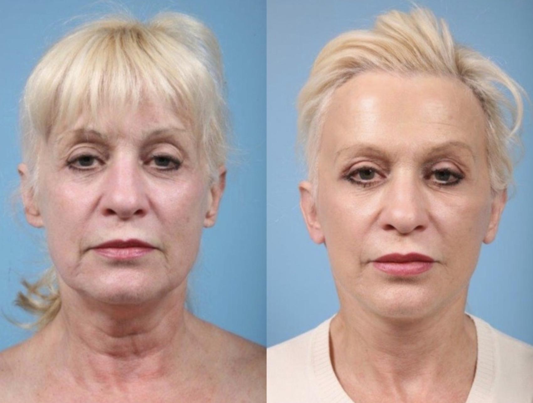 Before & After Deep Plane Facelift by Dr. Mustoe Case 889 Front View in Chicago, IL