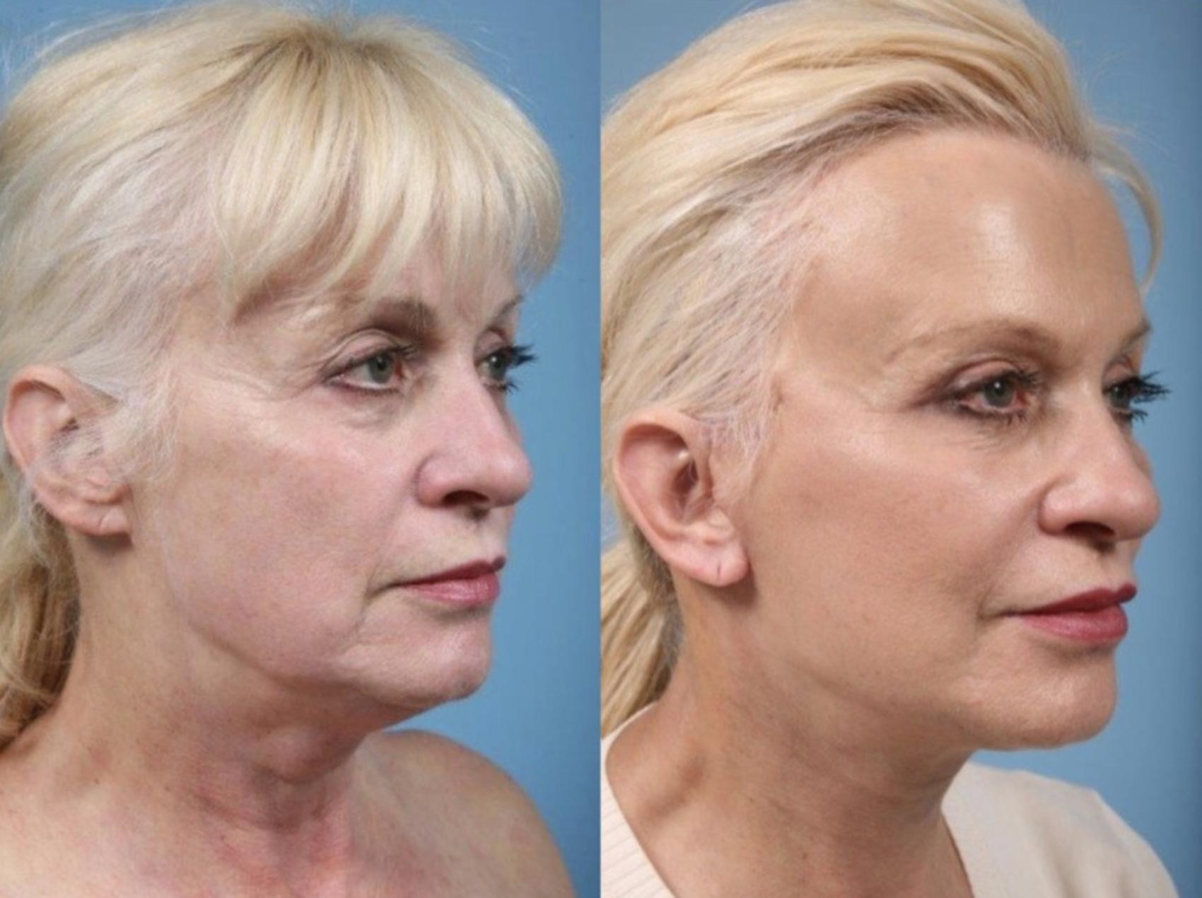 Before & After Deep Plane Facelift by Dr. Mustoe Case 889 Right Oblique View in Chicago, IL