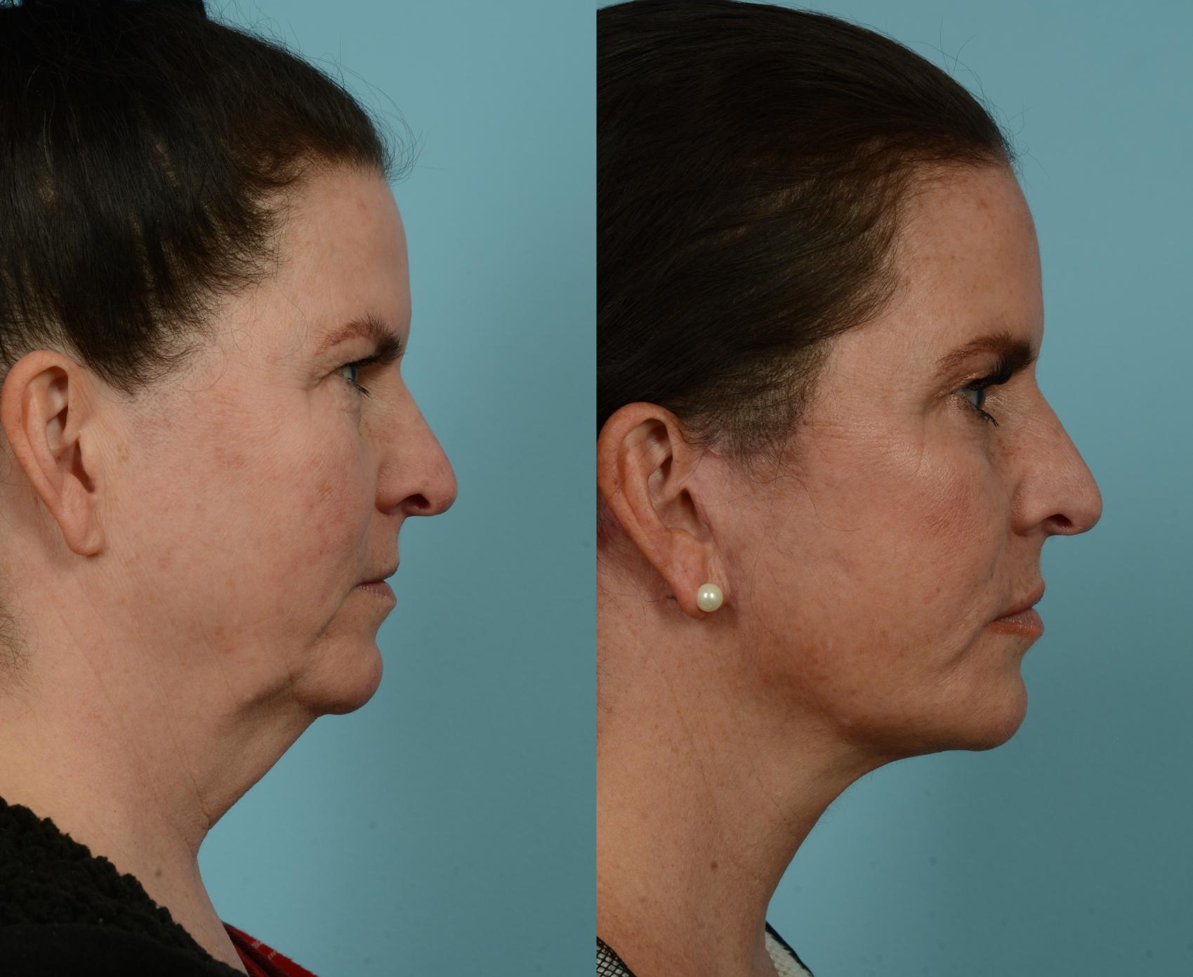 Before & After Deep Plane Facelift by Dr. Mustoe Case 937 Right Side View in Chicago, IL