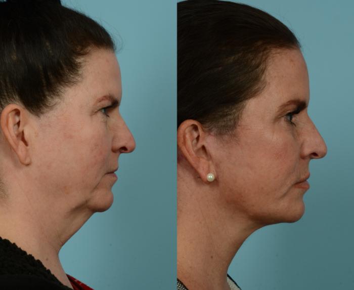 Before & After Deep Plane Facelift by Dr. Mustoe Case 937 Right Side View in Chicago, IL