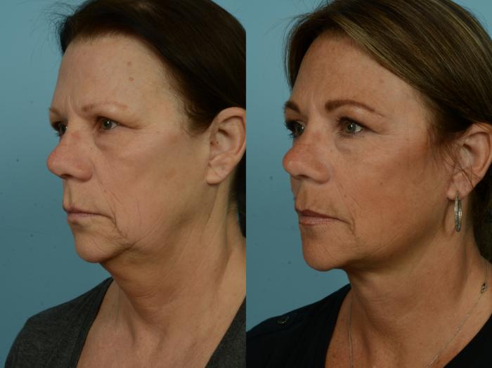 Before & After Deep Plane Facelift by Dr. Mustoe Case 973 Left Oblique View in Chicago, IL