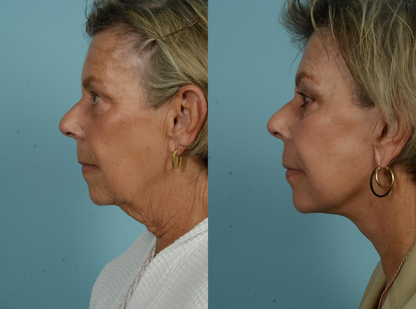 Before & After Deep Plane Facelift by Dr. Mustoe Case 997 Left Side View in Chicago, IL