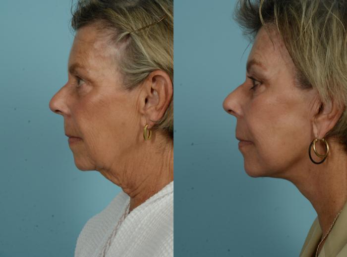 Before & After Deep Plane Facelift by Dr. Mustoe Case 997 Left Side View in Chicago, IL