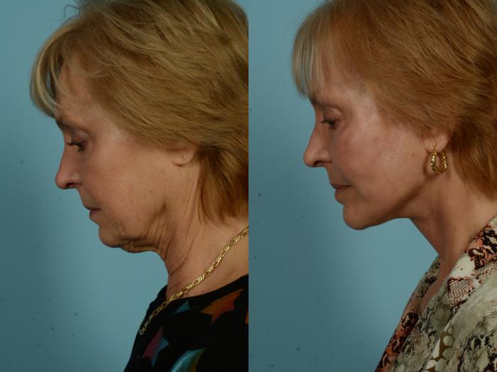 Before & After Dual Plane Facelift by Dr. Sinno Case 1010 Connell View View in Chicago, IL