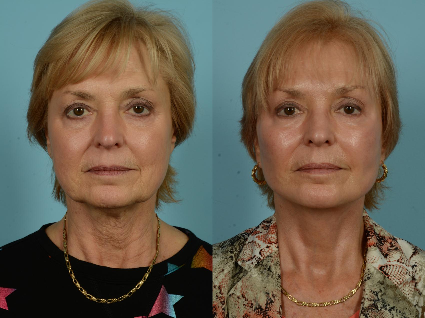 Before & After Dual Plane Facelift by Dr. Sinno Case 1010 Front View in Chicago, IL