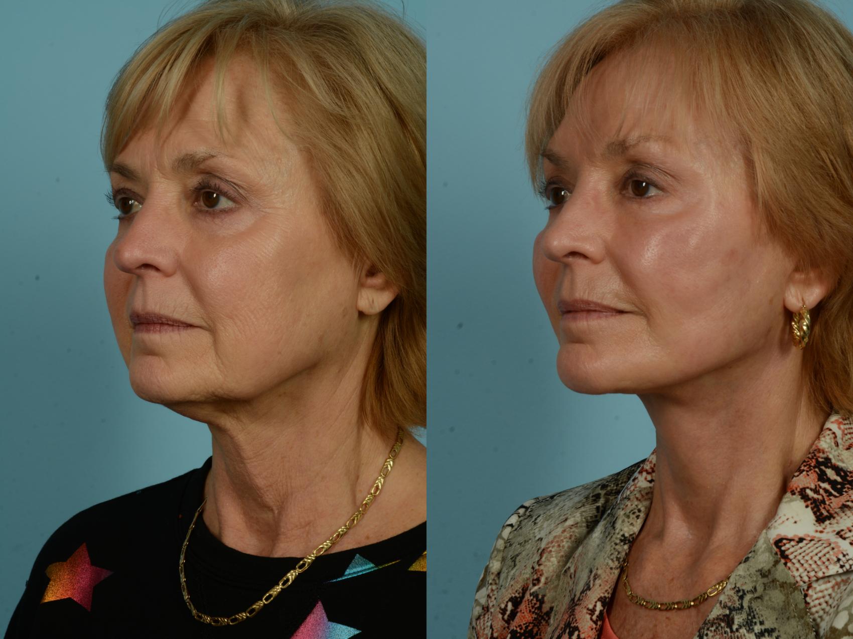 Before & After Dual Plane Facelift by Dr. Sinno Case 1010 Left Oblique View in Chicago, IL