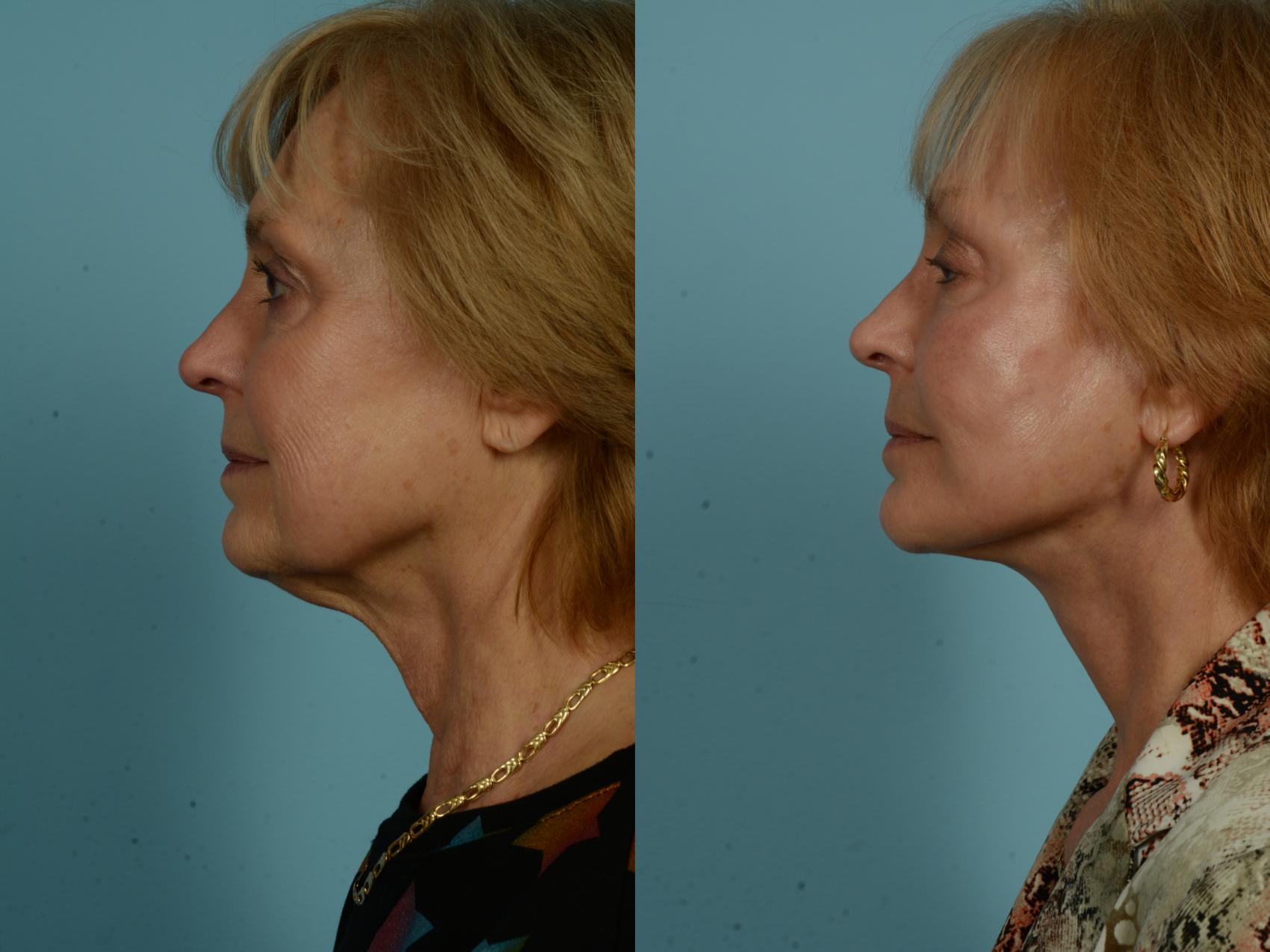Before & After Dual Plane Facelift by Dr. Sinno Case 1010 Left Side View in Chicago, IL