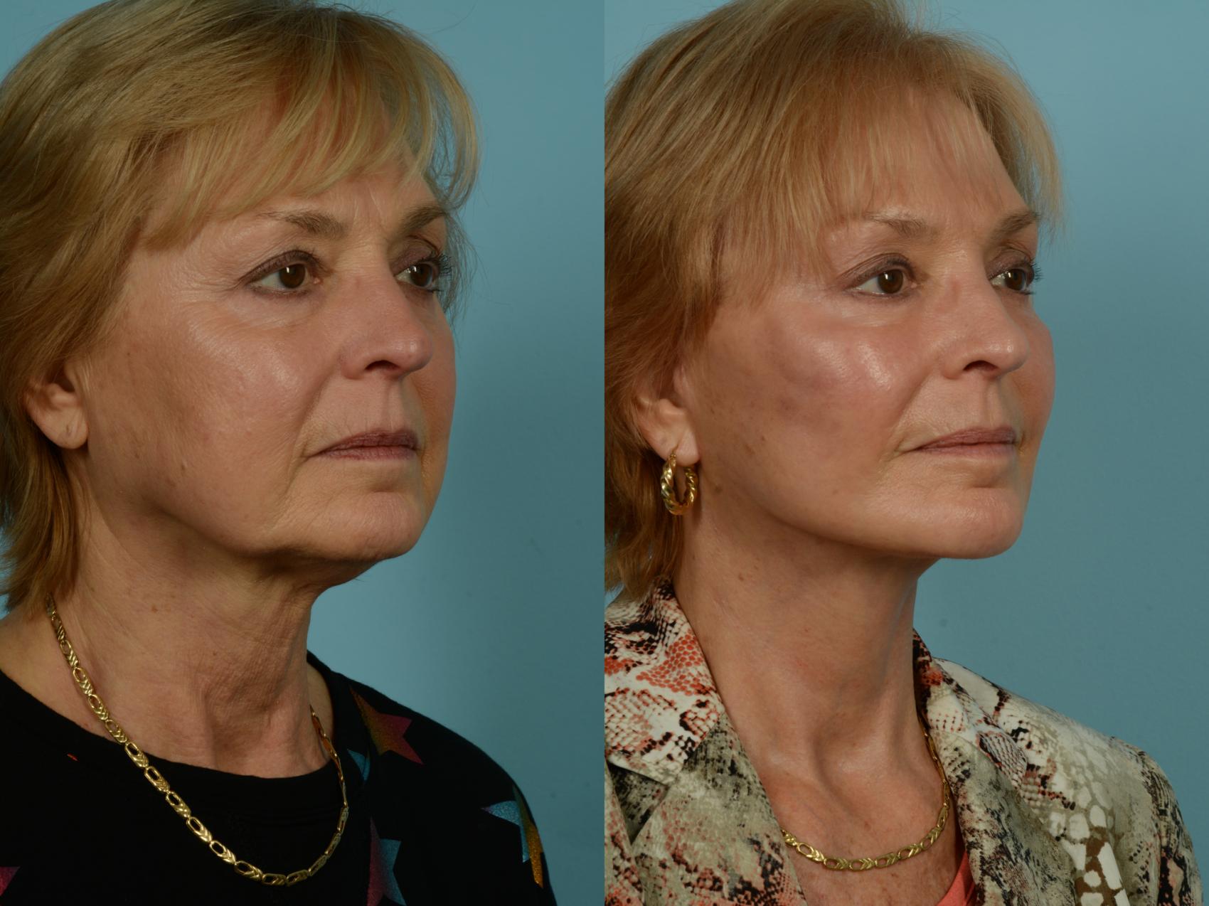 Before & After Dual Plane Facelift by Dr. Sinno Case 1010 Right Oblique View in Chicago, IL
