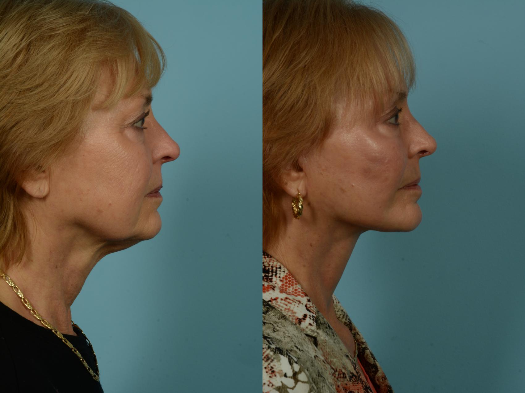Before & After Dual Plane Facelift by Dr. Sinno Case 1010 Right Side View in Chicago, IL