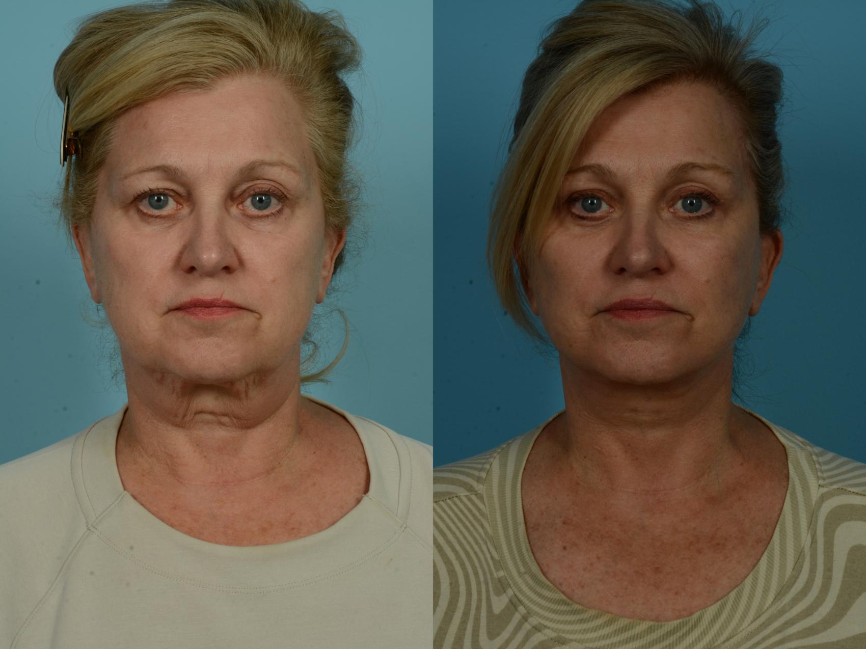Before & After Dual Plane Facelift by Dr. Sinno Case 1037 Front View in Chicago, IL