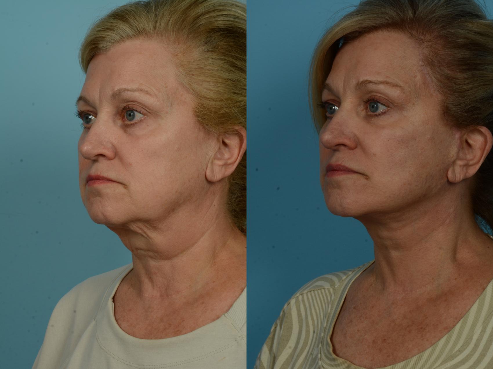 Before & After Neck Lift by Dr. Sinno Case 1037 Left Oblique View in Chicago, IL