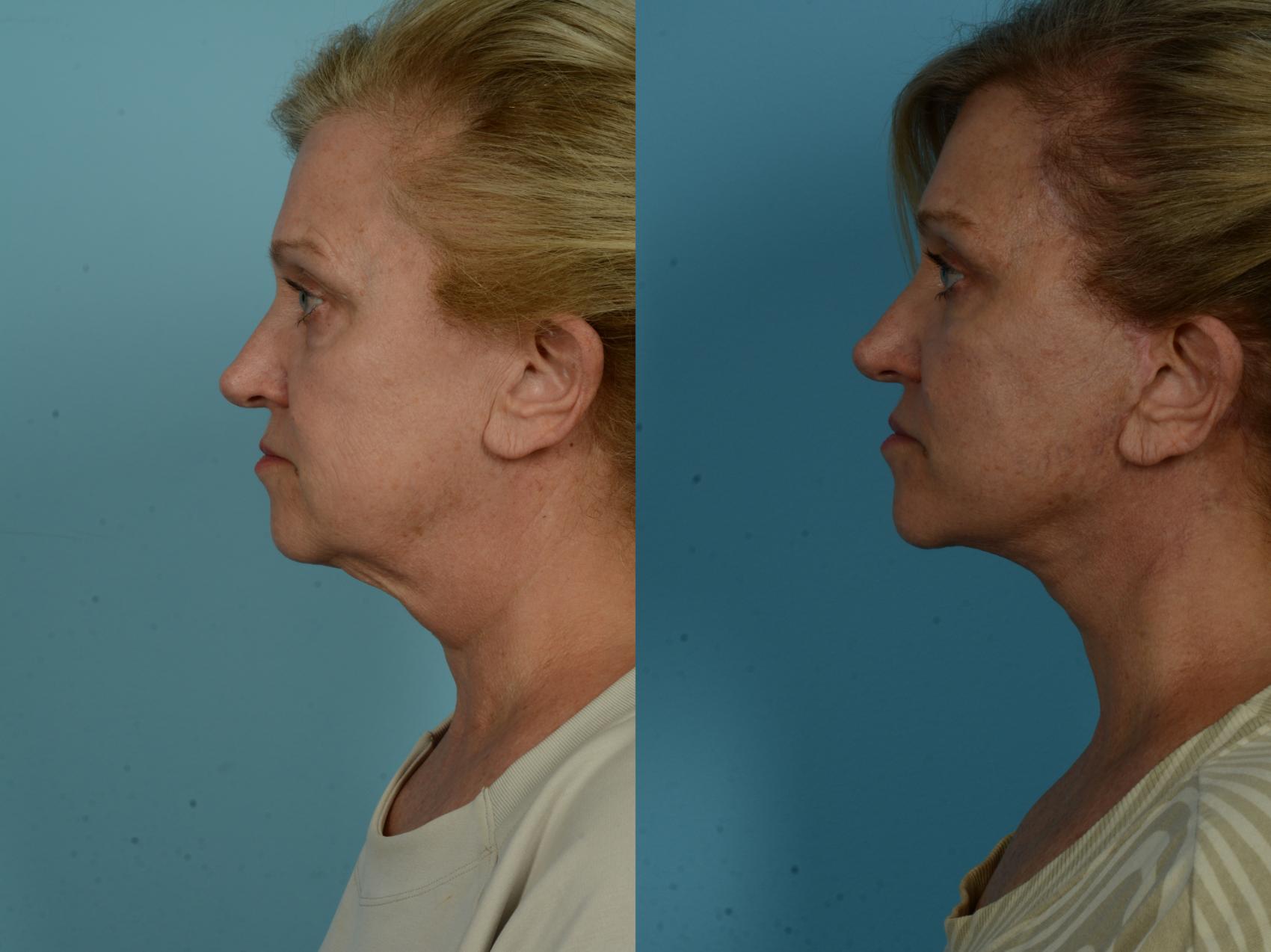 Before & After Neck Lift by Dr. Sinno Case 1037 Left Side View in Chicago, IL