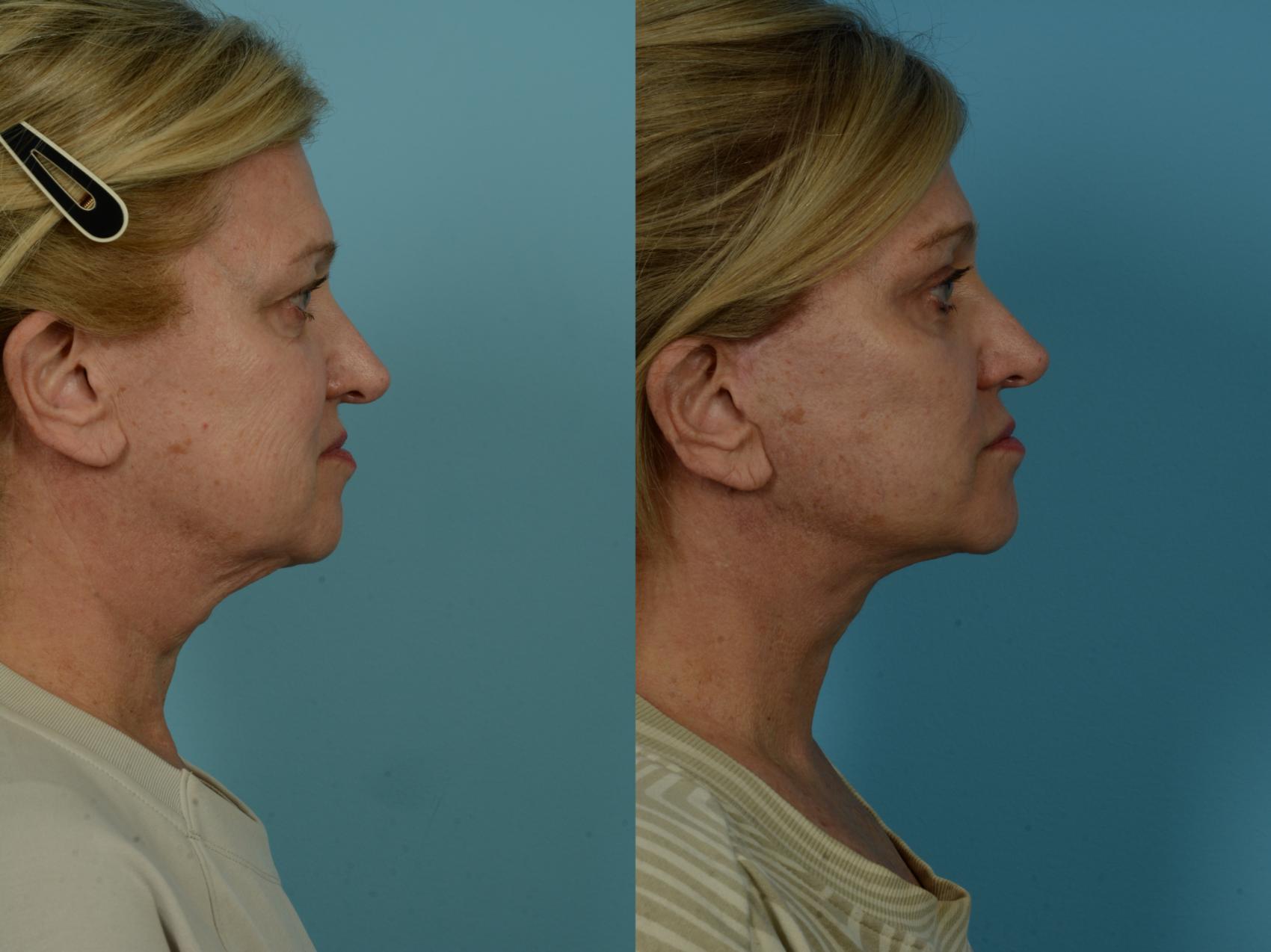 Before & After Neck Lift by Dr. Sinno Case 1037 Right Side View in Chicago, IL