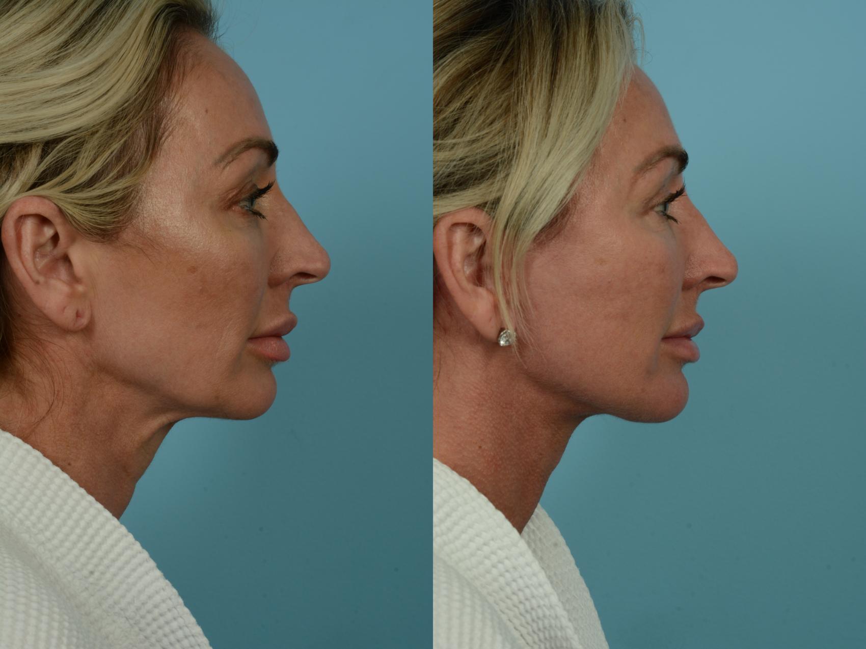 Before & After Dual Plane Facelift by Dr. Sinno Case 844 Right Side View in Chicago, IL