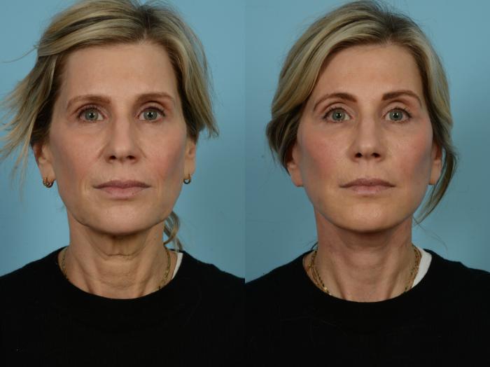 Before & After Dual Plane Facelift by Dr. Sinno Case 848 Front View in Chicago, IL