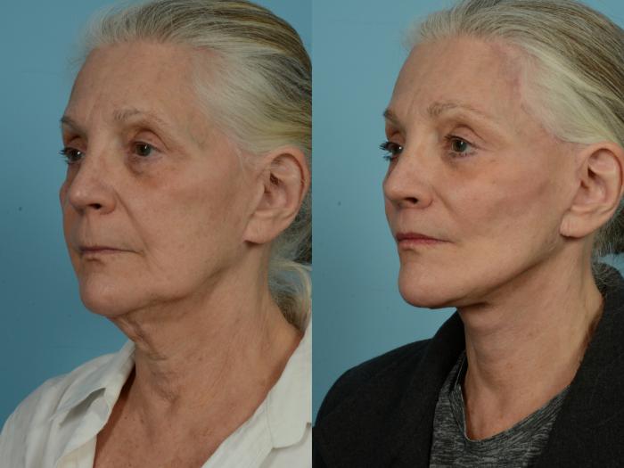 Before & After Dual Plane Facelift by Dr. Sinno Case 850 Left Oblique View in Chicago, IL